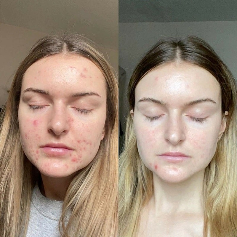 Tretinoin Before and After: A Comprehensive Analysis of its Effectiveness on Skin