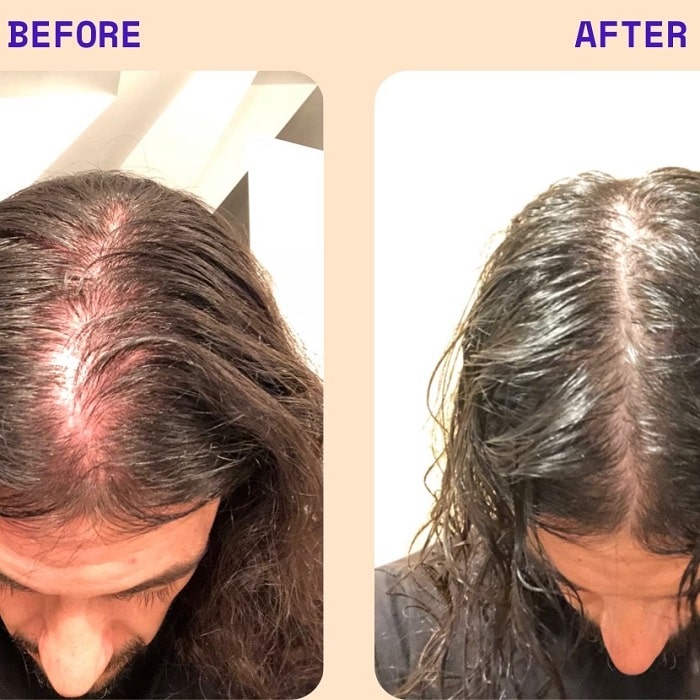 Minoxidil Before and After: Real Results and Photos