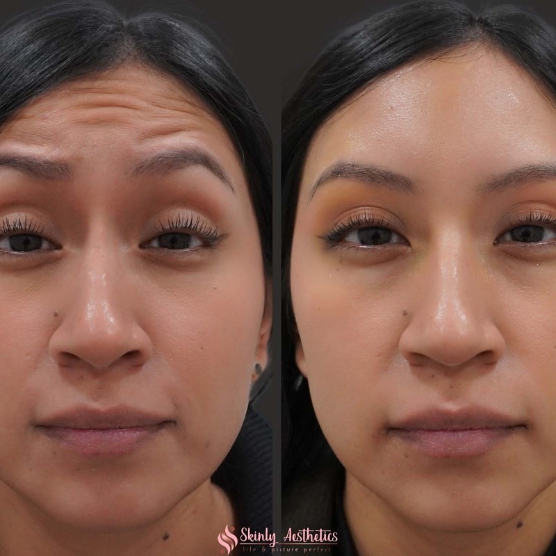 Botox Before and After: Dramatic Results and What to Expect