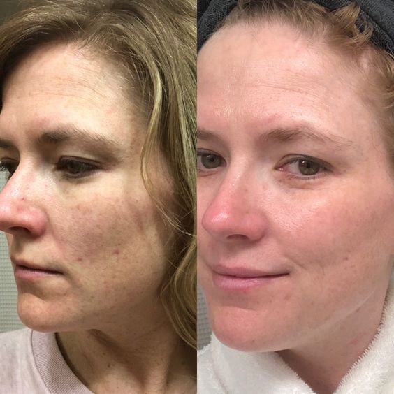Retinol Before and After: Transform Your Skin with These Results 23 Retinol Before and After: Transform Your Skin with These Results
