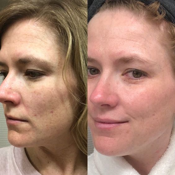 Retinol Before and After: Transform Your Skin with These Results