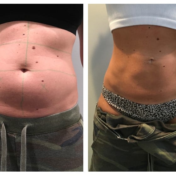 Coolsculpting Before and After: Results, Side Effects, and What to Expect 23 Coolsculpting Before and After: Results, Side Effects, and What to Expect