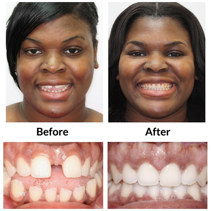 Invisalign Before and After: Transforming Your Smile with Clear Aligners