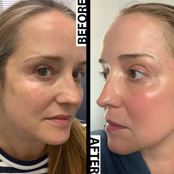 Tretinoin Before and After A Comprehensive Analysis of its