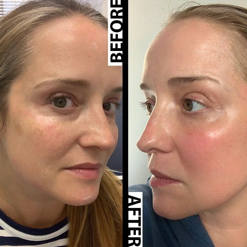 Tretinoin Before and After: A Comprehensive Analysis of its Effectiveness on Skin