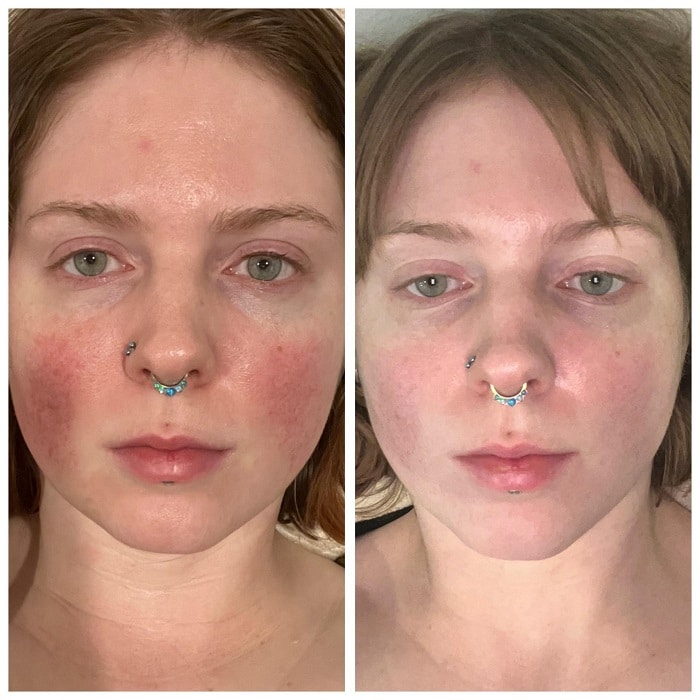 Gua Sha Before and After: Benefits and Results 24 Gua Sha Before and After: Benefits and Results