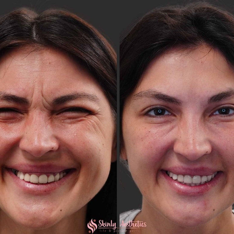Botox Before and After: Dramatic Results and What to Expect 25 Botox Before and After: Dramatic Results and What to Expect