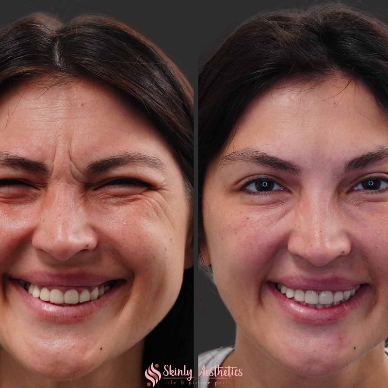 Botox Before and After: Dramatic Results and What to Expect