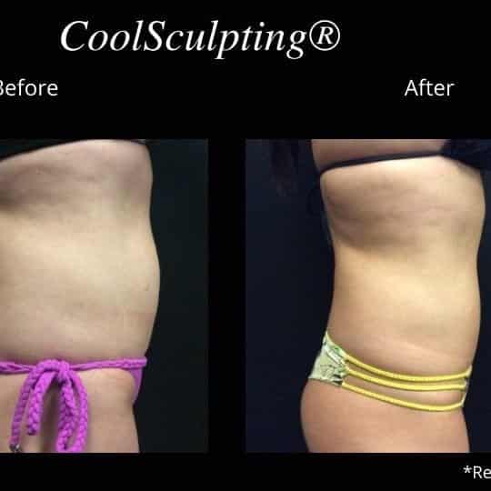 Coolsculpting Before and After: Results, Side Effects, and What to Expect 24 Coolsculpting Before and After: Results, Side Effects, and What to Expect