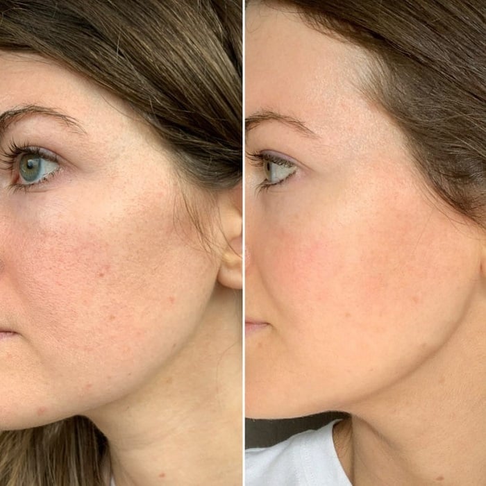 Retinol Before and After: Transform Your Skin with These Results