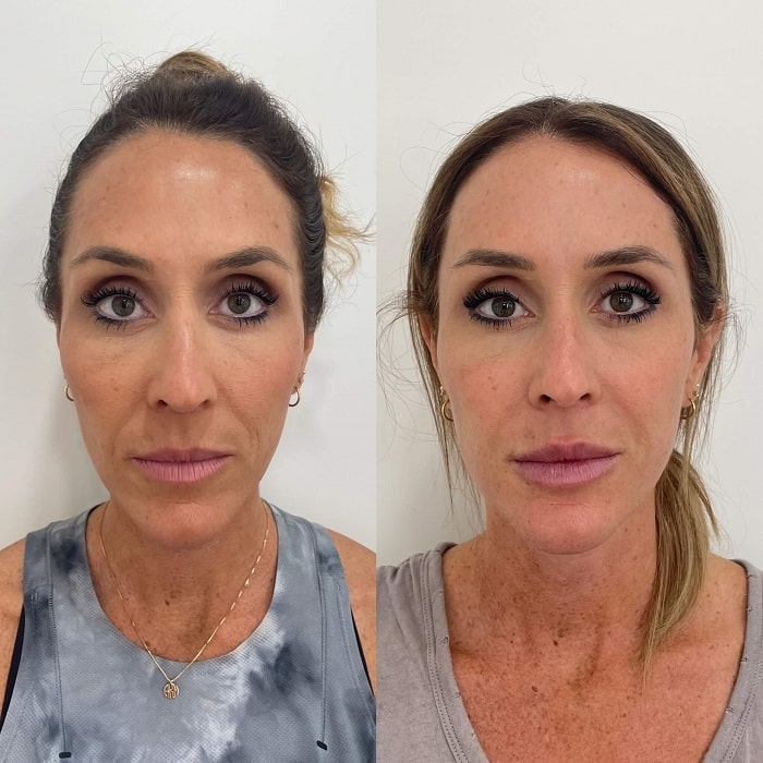 Sculptra Before and After: Transforming Your Appearance with Long-Lasting Results
