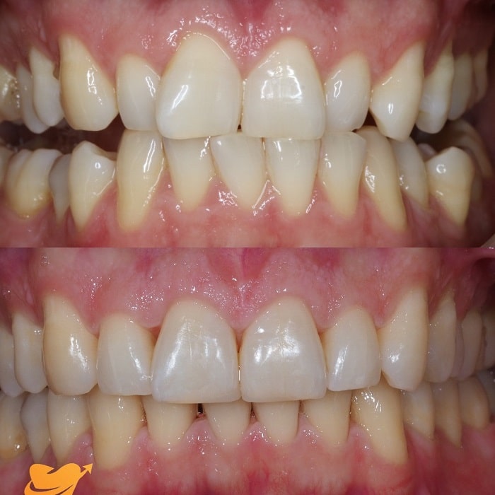 Invisalign Before and After: Transforming Your Smile with Clear Aligners