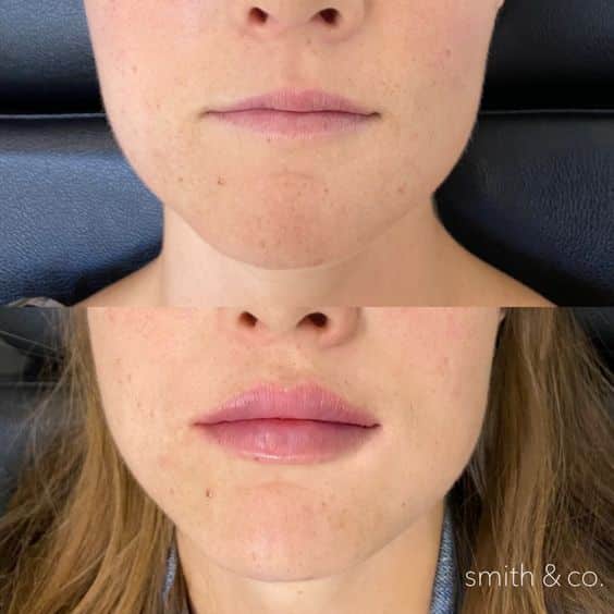 Lip Lift Before and After: Dramatic Results and Recovery Process