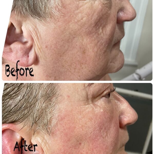 Gua Sha Before and After Benefits and Results Must Read This Before Buying