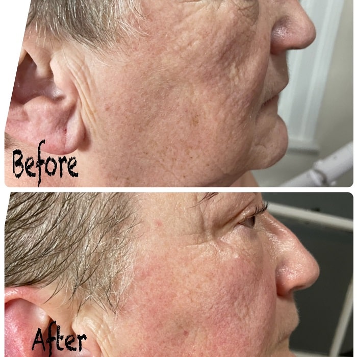 Gua Sha Before and After: Benefits and Results 25 Gua Sha Before and After: Benefits and Results