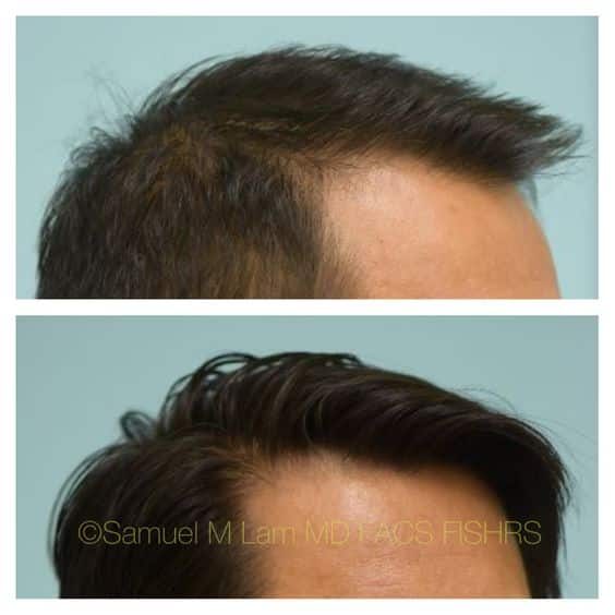 Minoxidil Before and After: Real Results and Photos