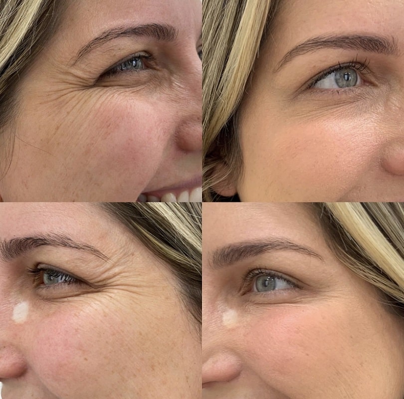 Botox Before and After: Dramatic Results and What to Expect