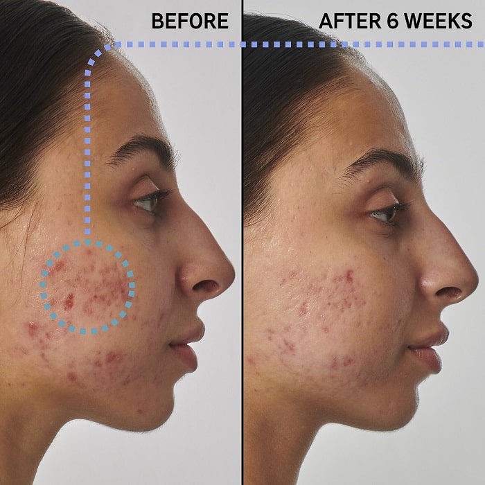 Retinol Before and After: Transform Your Skin with These Results 25 Retinol Before and After: Transform Your Skin with These Results