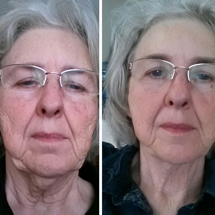 Red Light Therapy Before and After: Does It Really Work? 25 Red Light Therapy Before and After: Does It Really Work?