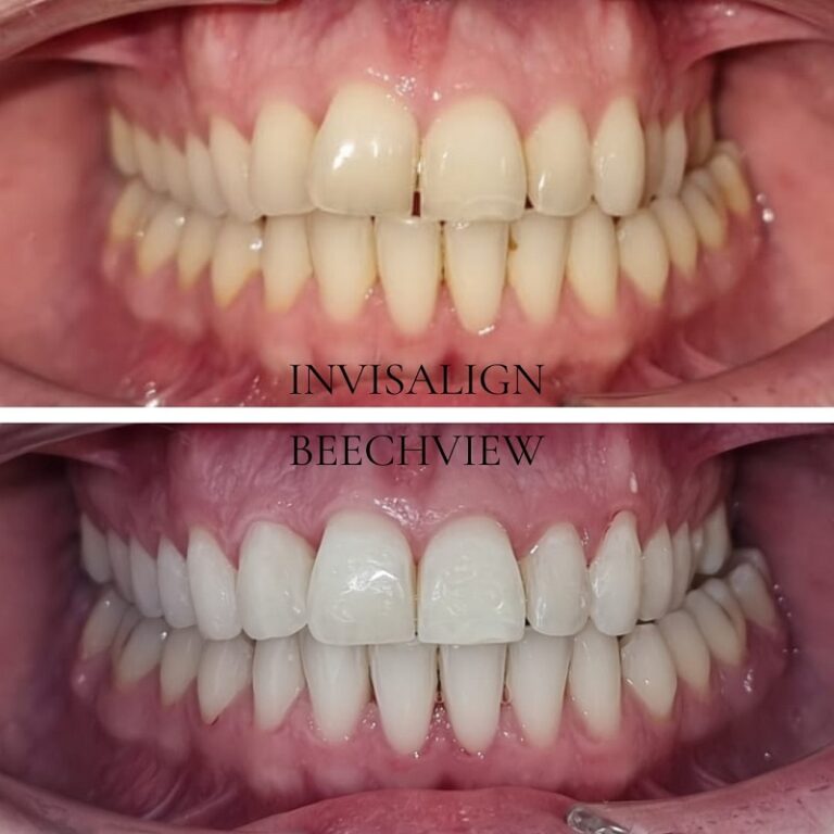 Invisalign Before and After: Transforming Your Smile with Clear ...
