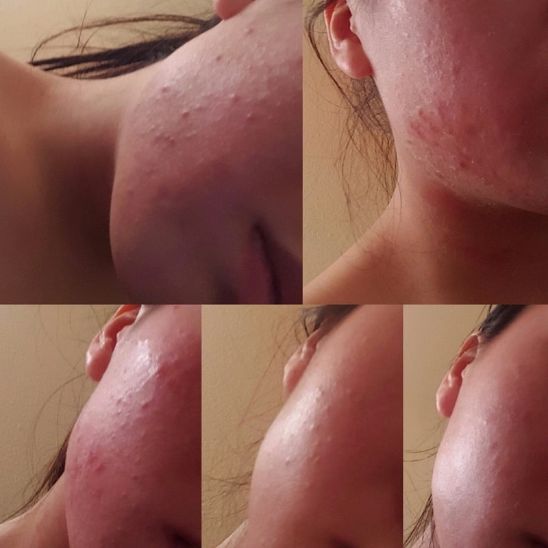 Tretinoin Before and After: A Comprehensive Analysis of its Effectiveness on Skin