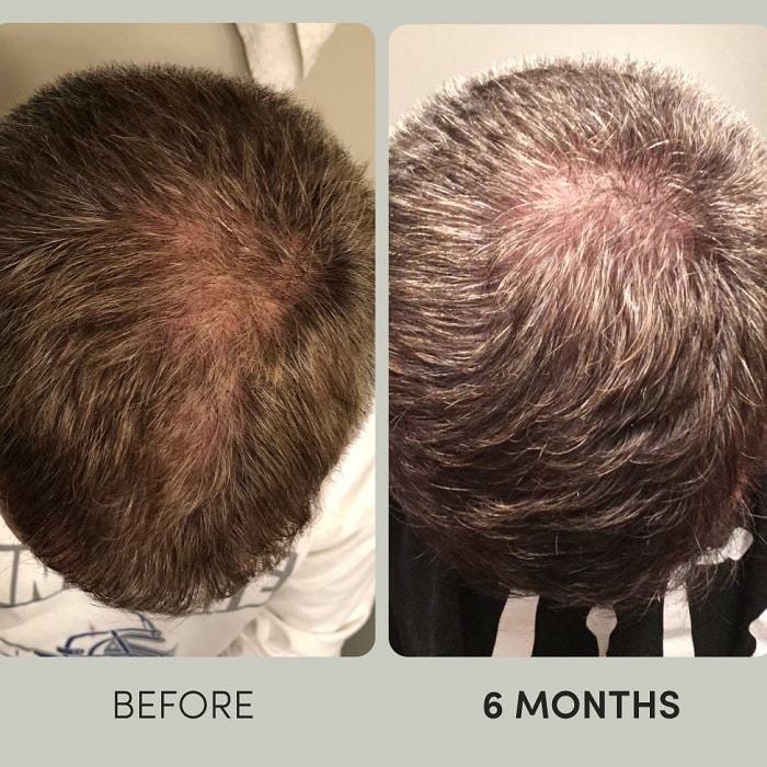 Minoxidil Before and After: Real Results and Photos