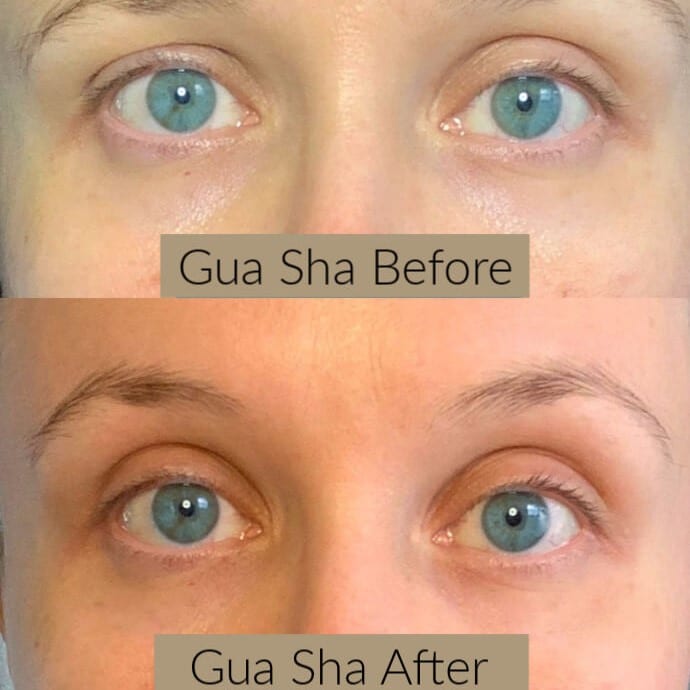 Gua Sha Before and After: Benefits and Results 26 Gua Sha Before and After: Benefits and Results