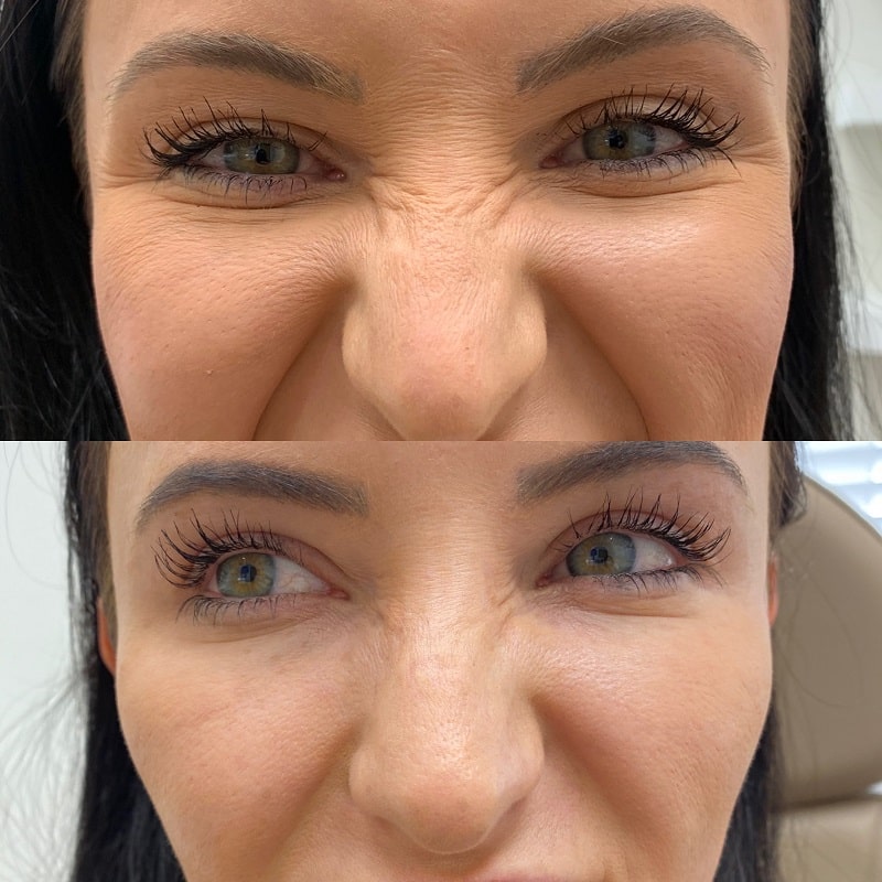 Botox Before and After: Dramatic Results and What to Expect