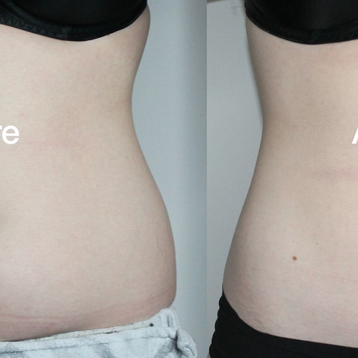 Coolsculpting Before and After: Results, Side Effects, and What to Expect 26 Coolsculpting Before and After: Results, Side Effects, and What to Expect