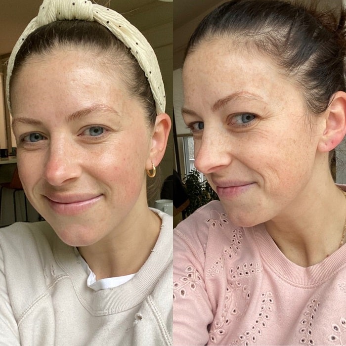 Retinol Before and After: Transform Your Skin with These Results 26 Retinol Before and After: Transform Your Skin with These Results