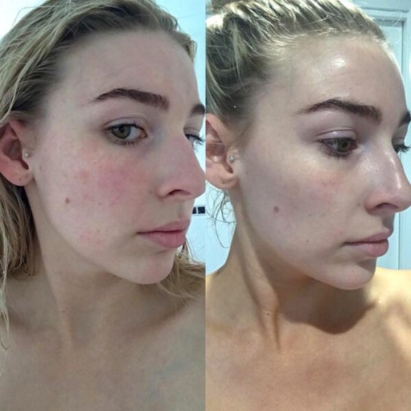 Red Light Therapy Before and After Does It Really Work? Must Read