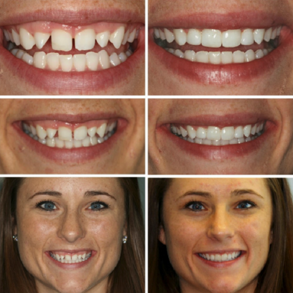 Invisalign Before and After: Transforming Your Smile with Clear ...