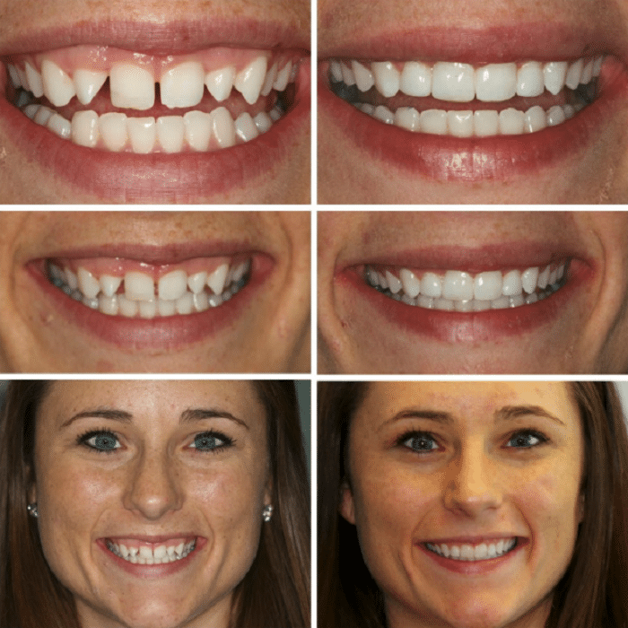 Invisalign Before and After: Transforming Your Smile with Clear Aligners