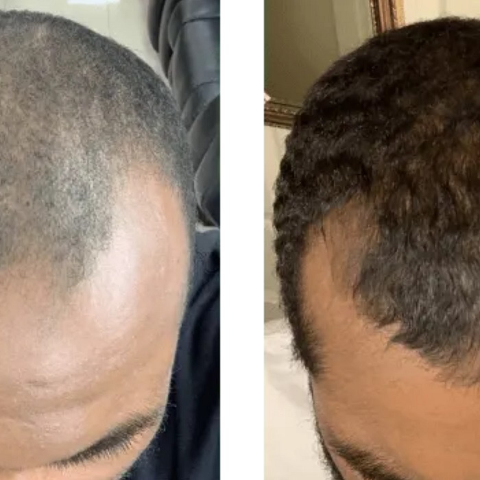 Minoxidil Before and After: Real Results and Photos