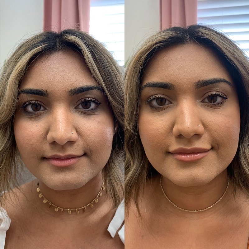 Botox Before and After: Dramatic Results and What to Expect 28 Botox Before and After: Dramatic Results and What to Expect