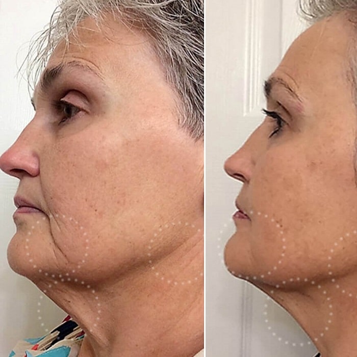 Red Light Therapy Before and After: Does It Really Work? 27 Red Light Therapy Before and After: Does It Really Work?