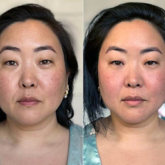 Gua Sha Before and After: Benefits and Results 28 Gua Sha Before and After: Benefits and Results