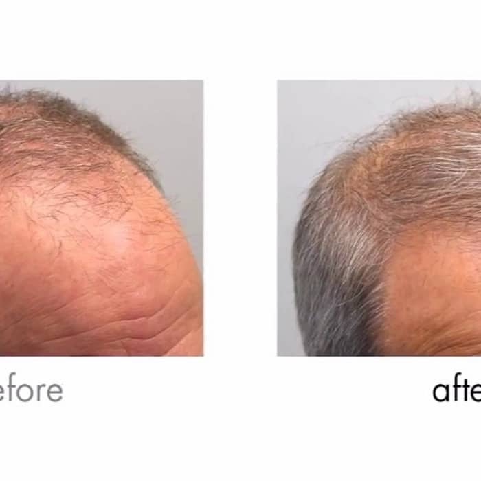 Minoxidil Before and After: Real Results and Photos