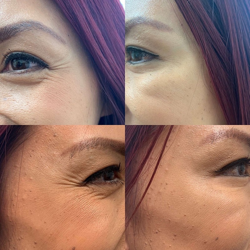 Botox Before and After: Dramatic Results and What to Expect