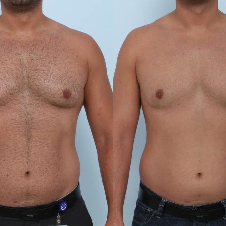 Coolsculpting Before and After: Results, Side Effects, and What to Expect 28 Coolsculpting Before and After: Results, Side Effects, and What to Expect