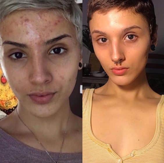 Retinol Before and After: Transform Your Skin with These Results 28 Retinol Before and After: Transform Your Skin with These Results