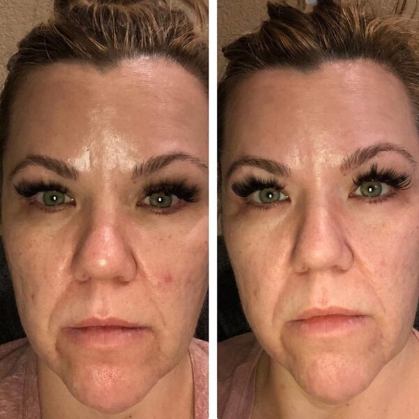 Red Light Therapy Before and After Does It Really Work? Must Read