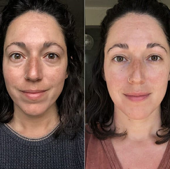 Gua Sha Before and After: Benefits and Results 29 Gua Sha Before and After: Benefits and Results