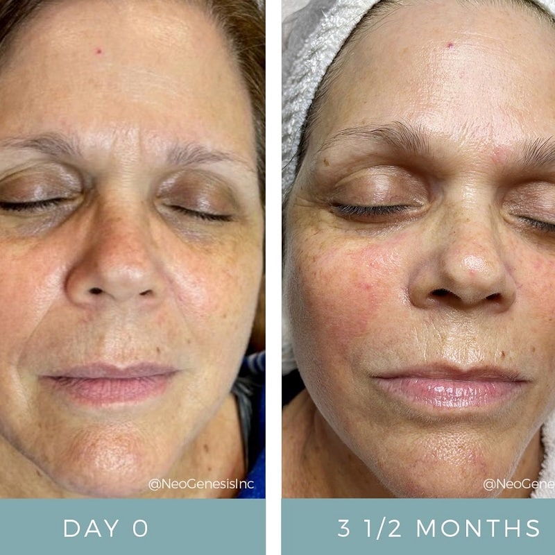 Tretinoin Before and After: A Comprehensive Analysis of its Effectiveness on Skin