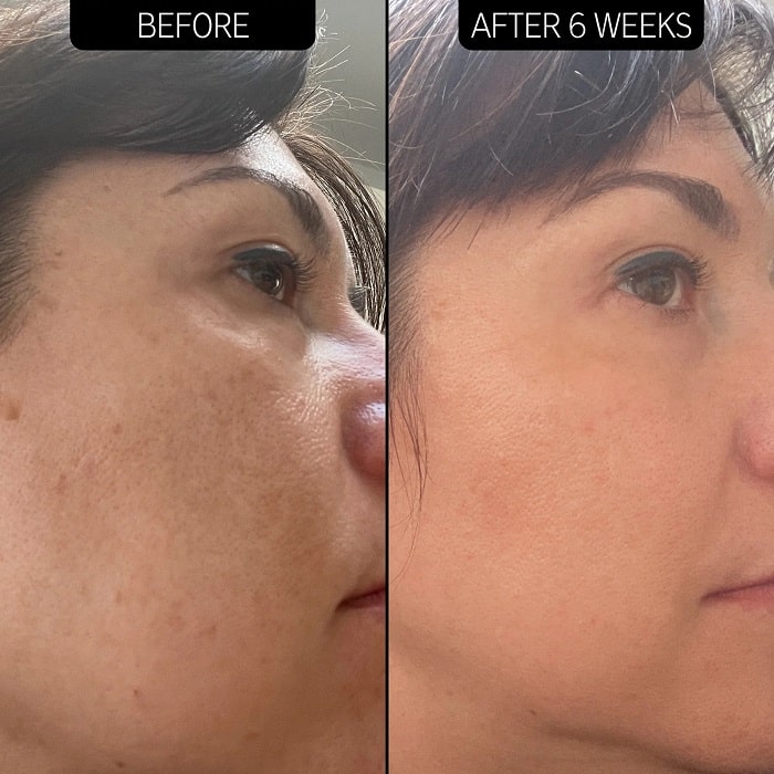 Retinol Before and After: Transform Your Skin with These Results 29 Retinol Before and After: Transform Your Skin with These Results
