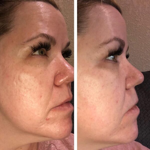 Red Light Therapy Before and After Does It Really Work? Must Read