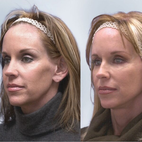 Sculptra Before and After Transforming Your Appearance with LongLasting Results Must Read