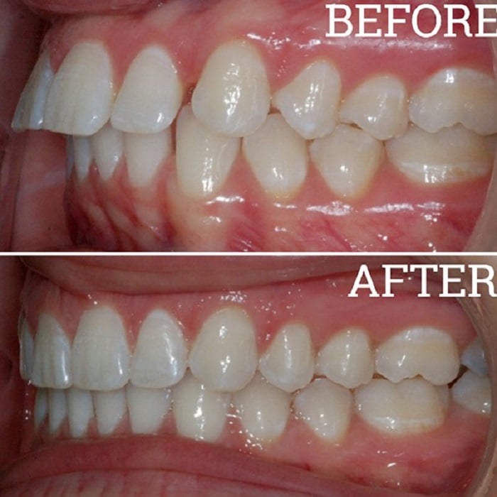 Invisalign Before and After: Transforming Your Smile with Clear Aligners