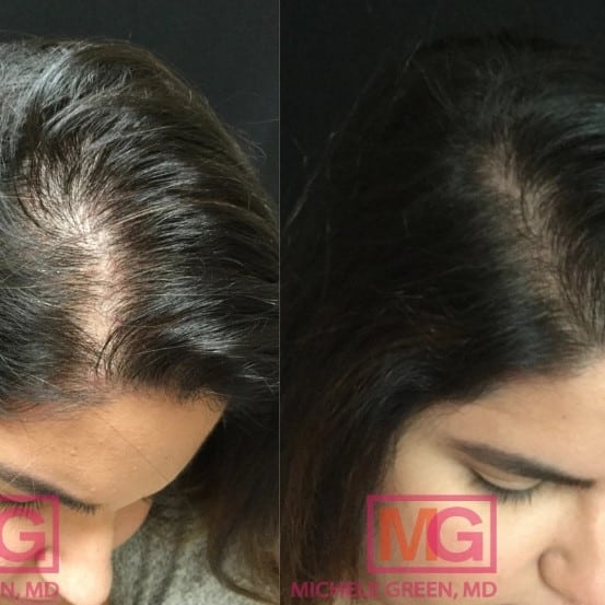 Minoxidil Before and After: Real Results and Photos