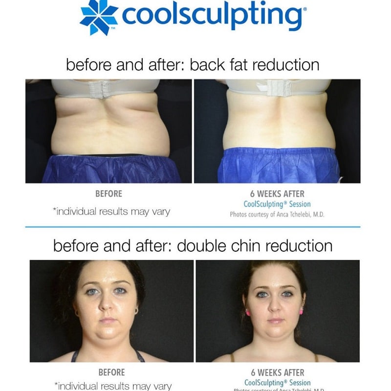 Coolsculpting Before and After: Results, Side Effects, and What to Expect 30 Coolsculpting Before and After: Results, Side Effects, and What to Expect